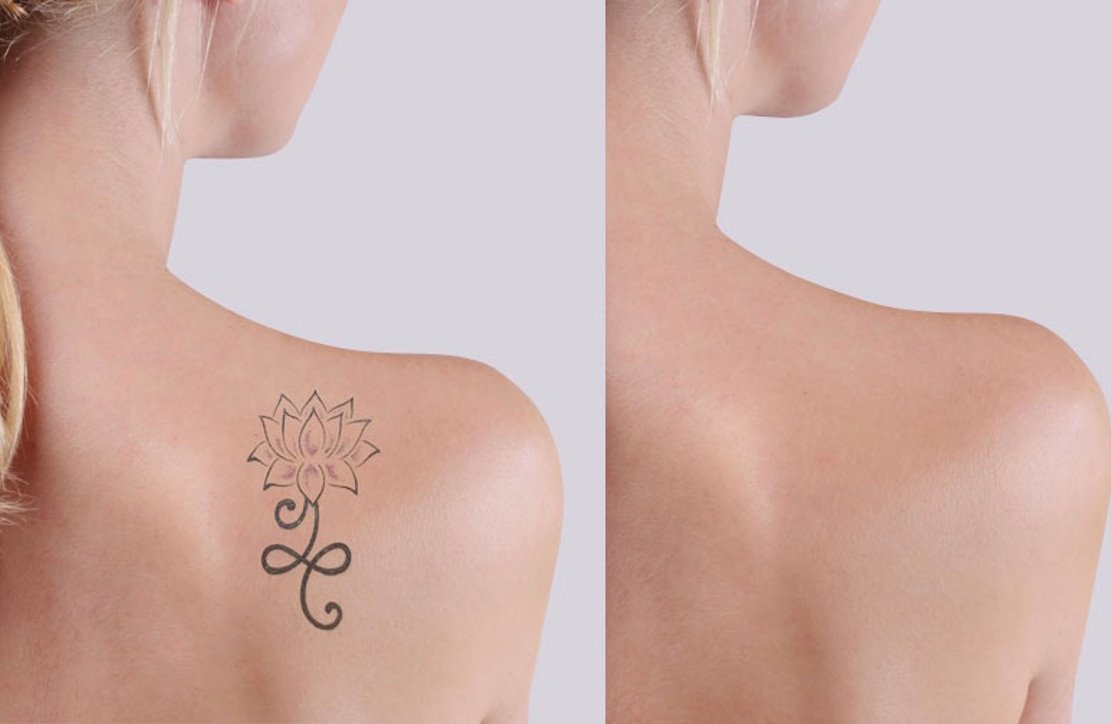 Tampa Laser Tattoo Removal Cost  Arviv Medical Aesthetics